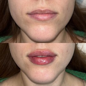 Контурная пластика губ