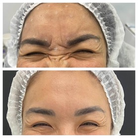 Ботулинотерапия