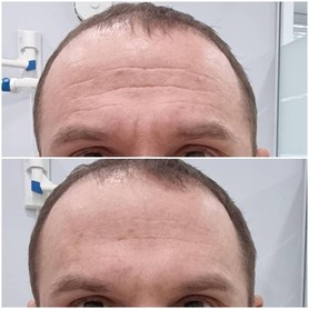Ботулинотерапия