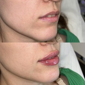 Контурная пластика губ