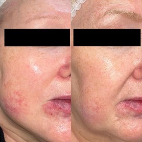 Фотоомоложение BBL