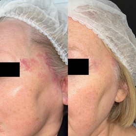 Фотоомоложение BBL