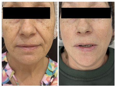 Фотоомоложение BBL