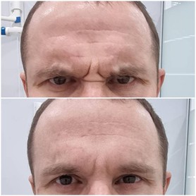 Ботулинотерапия