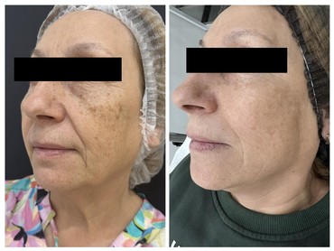 Фотоомоложение BBL