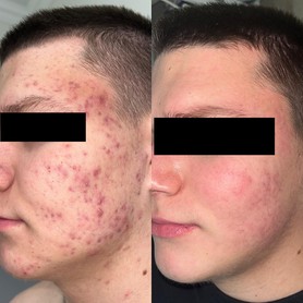 Лечение акне